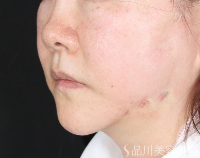 症例NO.73117のAFTER写真