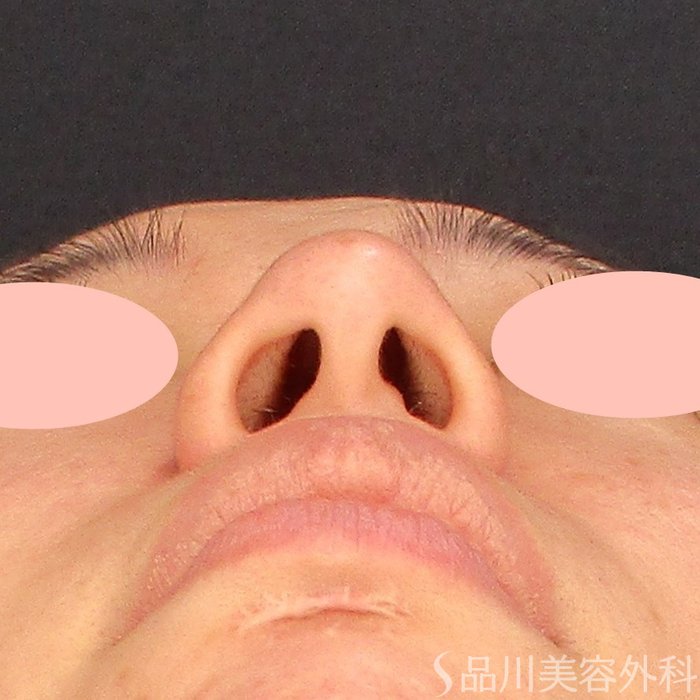症例NO.70276のBEFORE写真