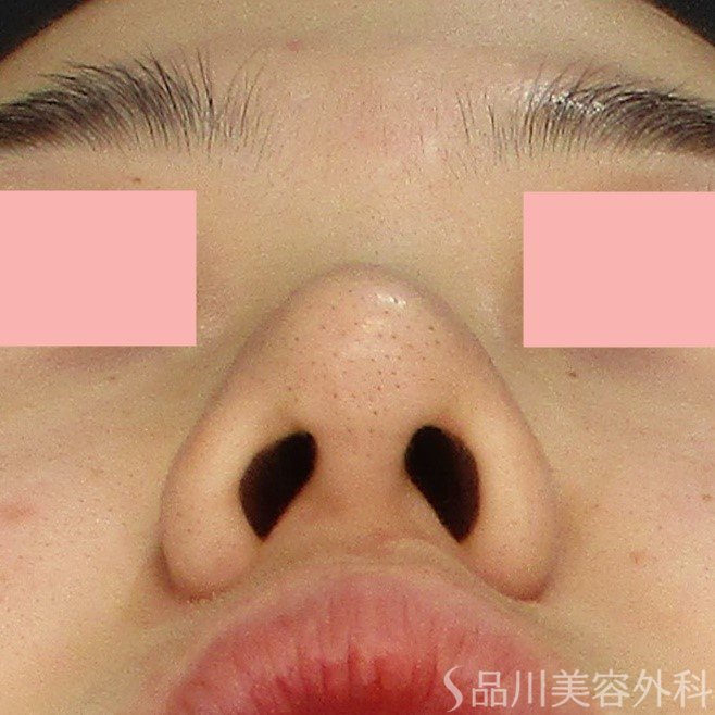 症例NO.71663のAFTER写真