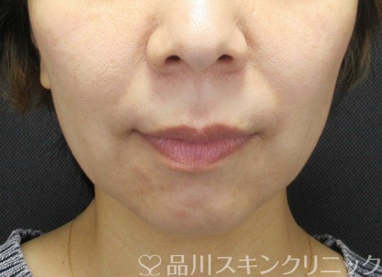 症例NO.69223のBEFORE写真