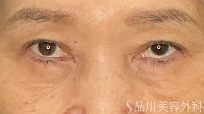 症例NO.71889のAFTER写真