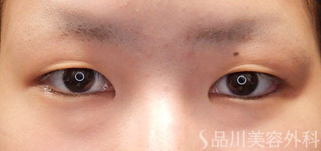 症例NO.72382のBEFORE写真