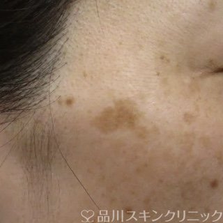 症例NO.64421のBEFORE写真