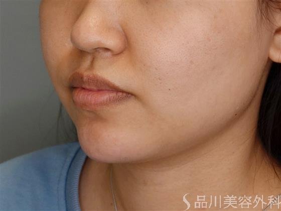 症例NO.51066のAFTER写真