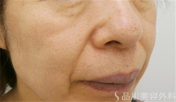 症例NO.20789のAFTER写真