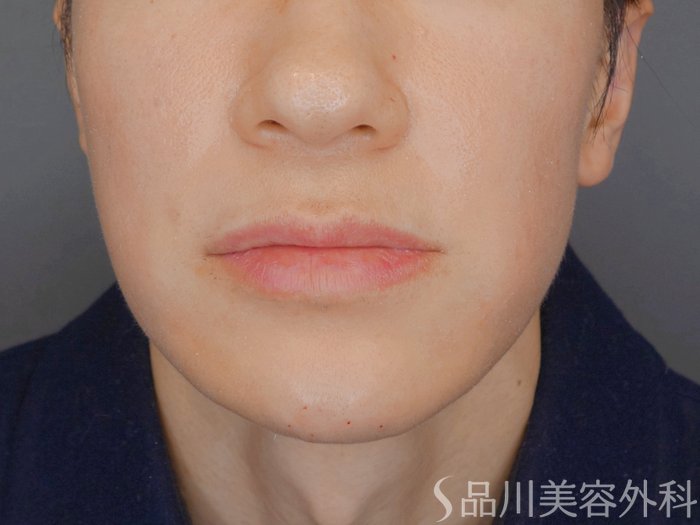 症例NO.73081のAFTER写真