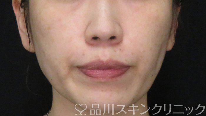 症例NO.70866のBEFORE写真
