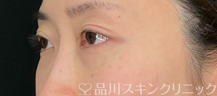 症例NO.74914のBEFORE写真