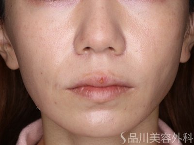 症例NO.72983のAFTER写真