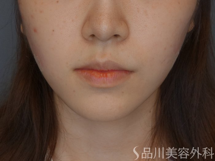 症例NO.71175のAFTER写真