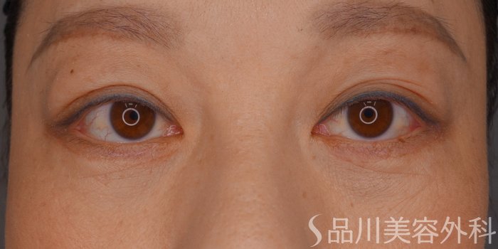 症例NO.62515のAFTER写真