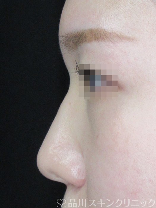 症例NO.69416のBEFORE写真