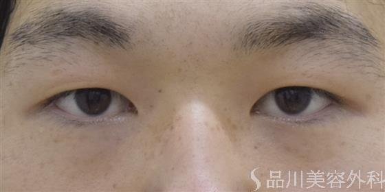 症例NO.52435のBEFORE写真