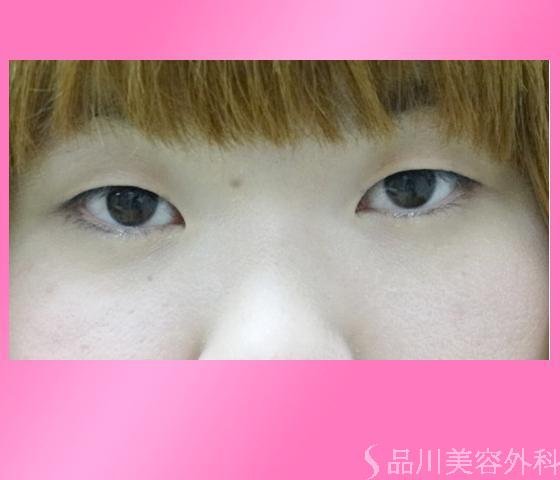 症例NO.16091のBEFORE写真