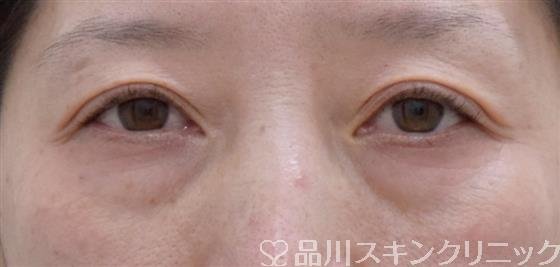 症例NO.58940のBEFORE写真
