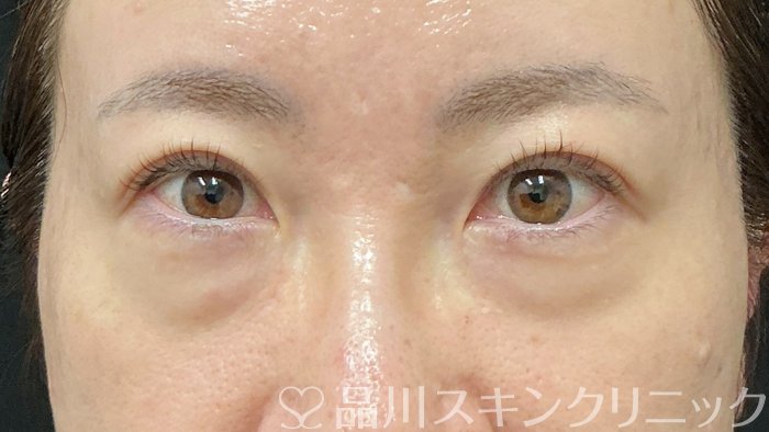 症例NO.74592のBEFORE写真