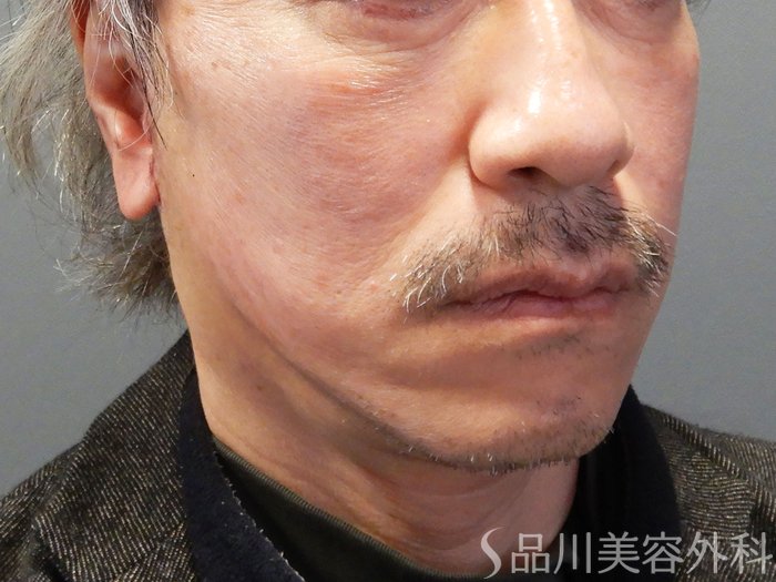 症例NO.70137のAFTER写真
