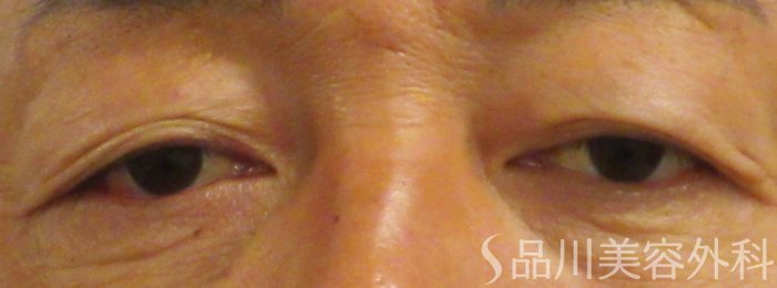 症例NO.70447のBEFORE写真