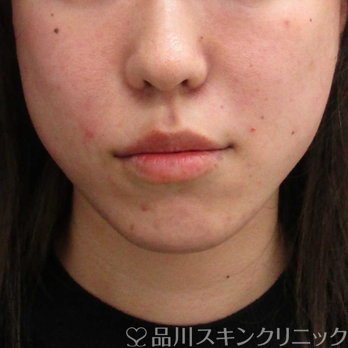 症例NO.65434のAFTER写真