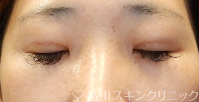 症例NO.64057のAFTER写真
