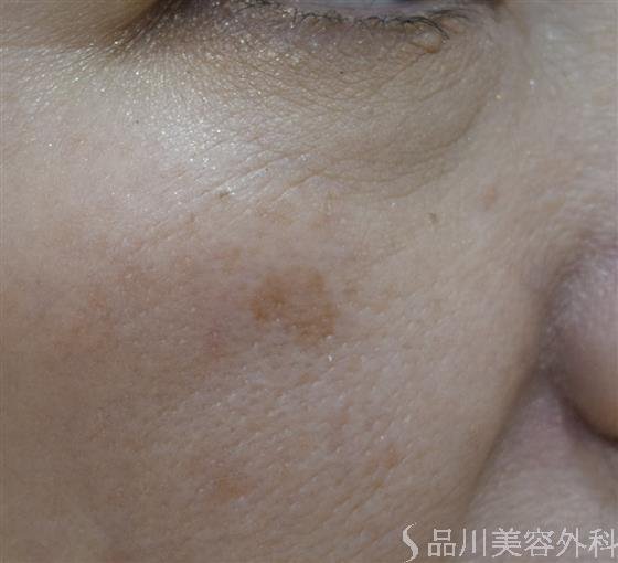 症例NO.45649のBEFORE写真