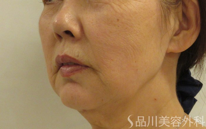 症例NO.70843のBEFORE写真