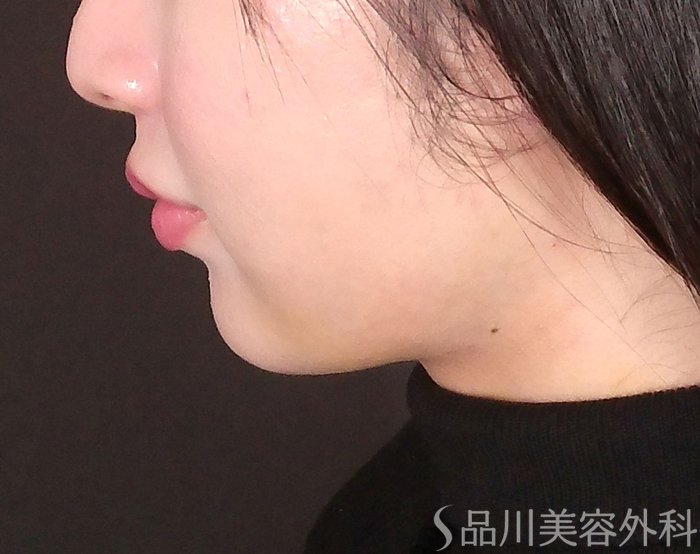 症例NO.69590のBEFORE写真