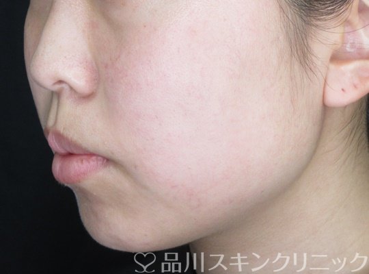 症例NO.70309のBEFORE写真