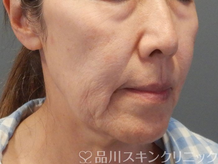 症例NO.69477のBEFORE写真