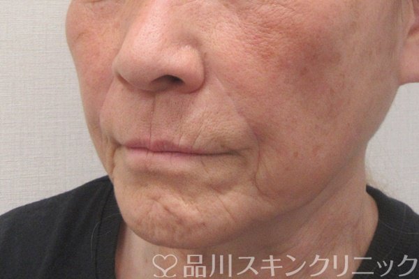 症例NO.70880のAFTER写真