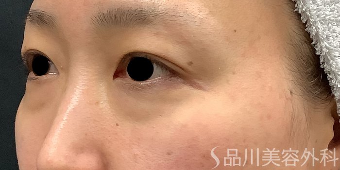 症例NO.69662のBEFORE写真