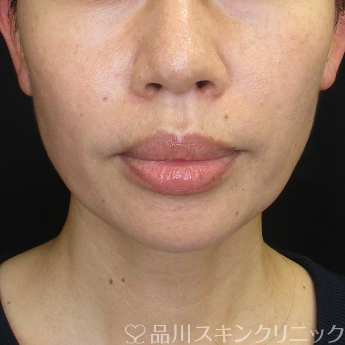 症例NO.73711のBEFORE写真