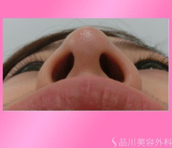 症例NO.14379のAFTER写真