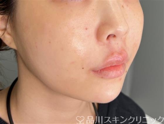 症例NO.55461のAFTER写真