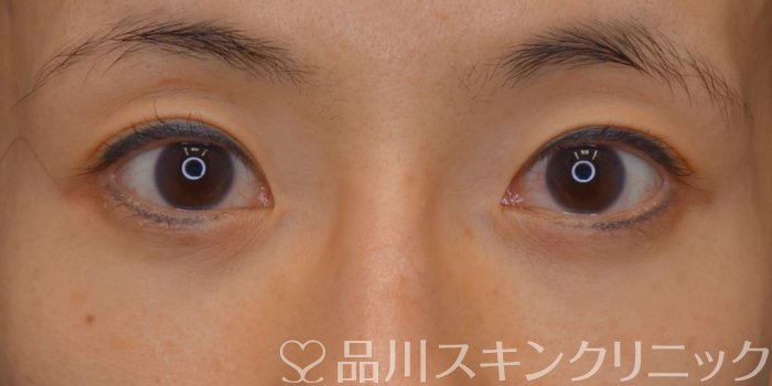 症例NO.73839のBEFORE写真