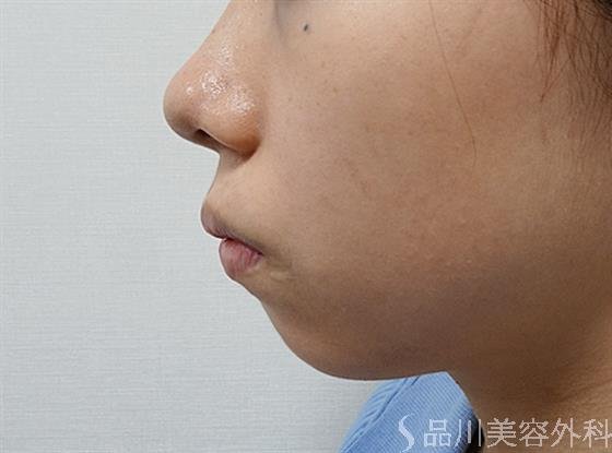 症例NO.52024のBEFORE写真
