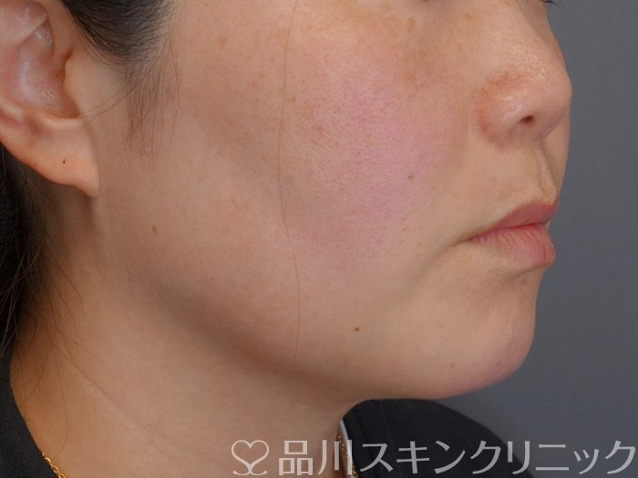 症例NO.74567のBEFORE写真