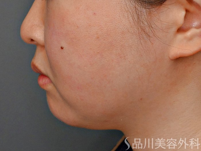 症例NO.73744のBEFORE写真