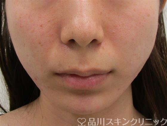 症例NO.36919のAFTER写真