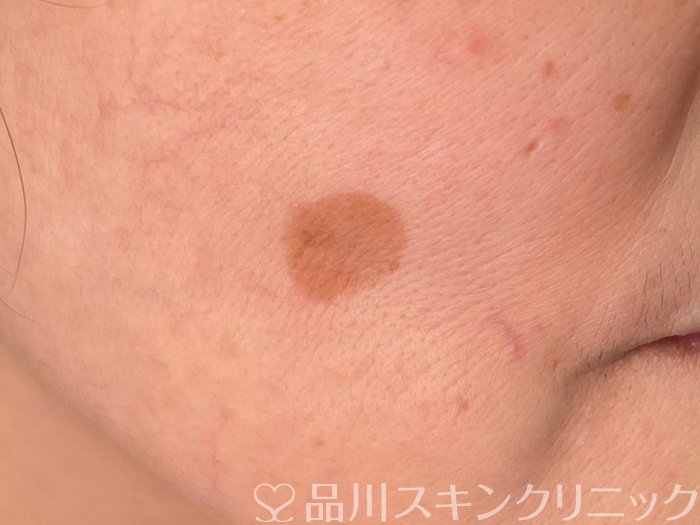 症例NO.65711のBEFORE写真