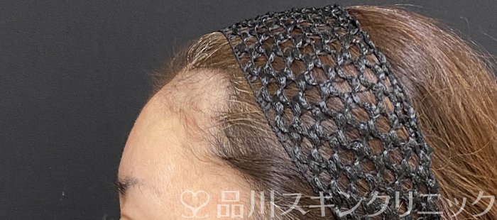 症例NO.74651のAFTER写真