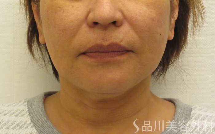 症例NO.73445のBEFORE写真