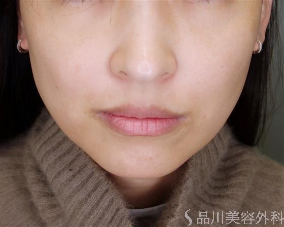 症例NO.49504のBEFORE写真