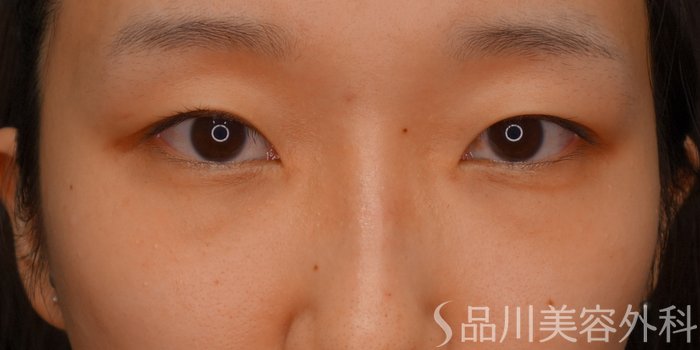 症例NO.74470のBEFORE写真