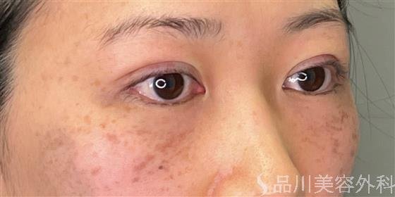 症例NO.53676のAFTER写真