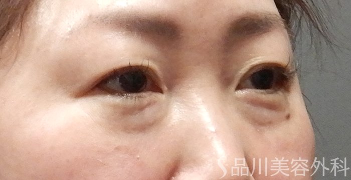 症例NO.63952のBEFORE写真