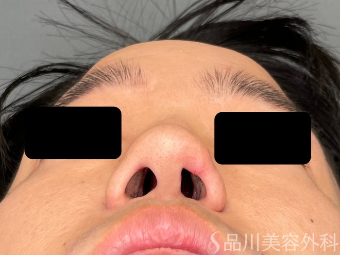 症例NO.75237のBEFORE写真