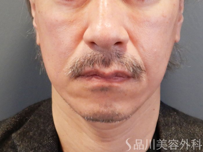 症例NO.70468のAFTER写真