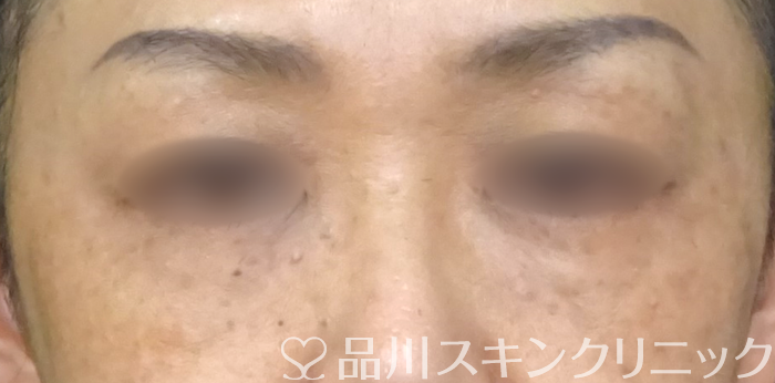 症例NO.69446のBEFORE写真