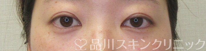 症例NO.74203のAFTER写真